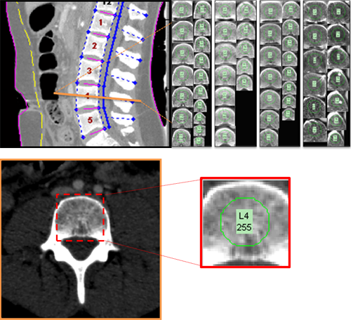 Spinal Measures (trabecular bone)